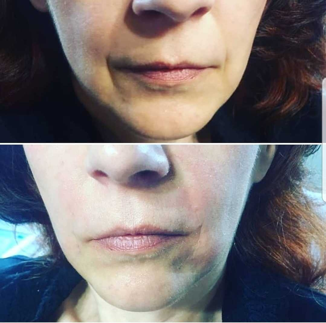 Grossi cosmetic #beograd Tretman lica