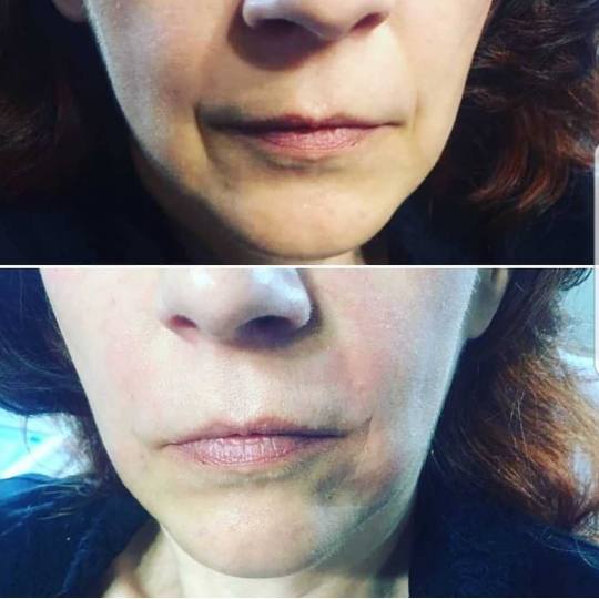 Grossi cosmetic #beograd Tretman lica