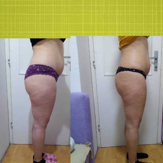 First lady #beograd Anticelulit masaža Maderoterapija - paket od 10 tretmana