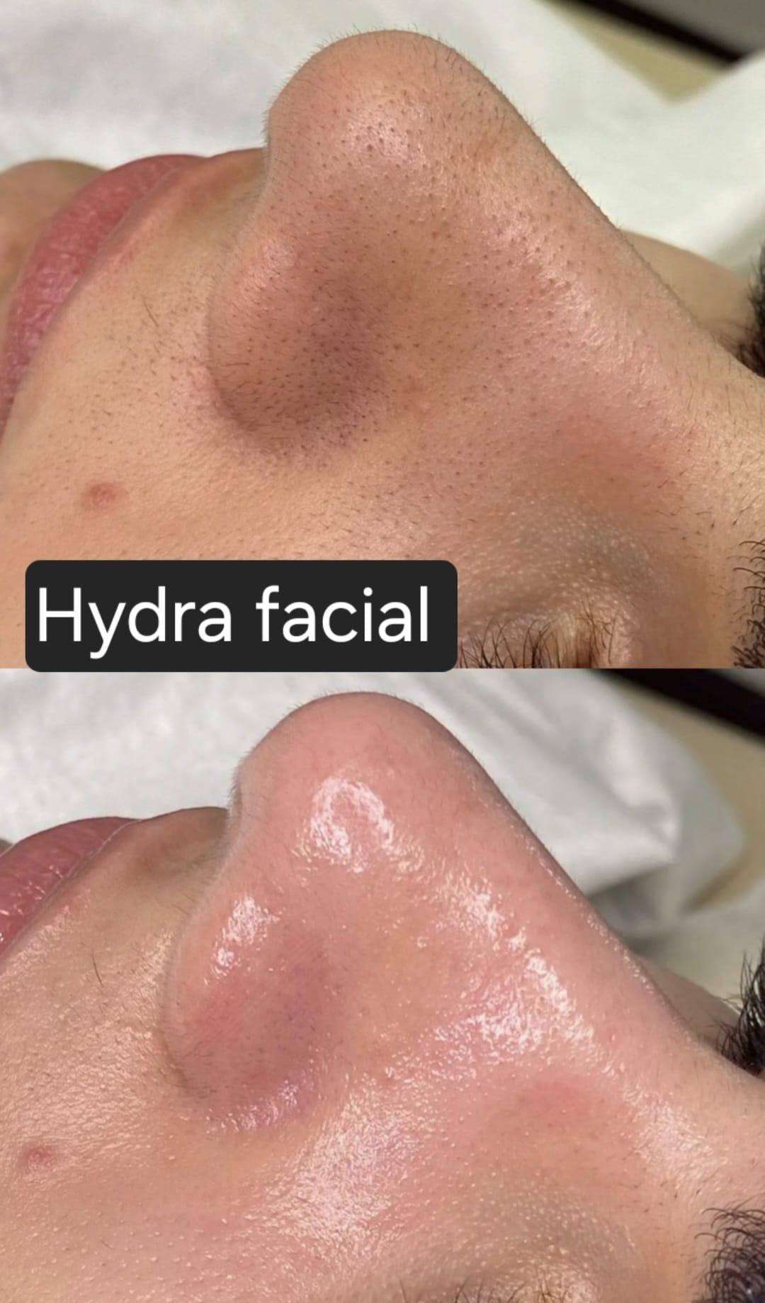 Mila Beauty Centar #beograd Tretman lica Hydrafacial - holivudski tretman lica