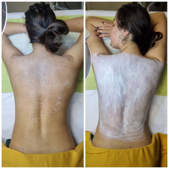 Emilly #beograd Tretman lica Higijenski tretman leđa Higijenski tretman leđa: Mislite na vreme o t