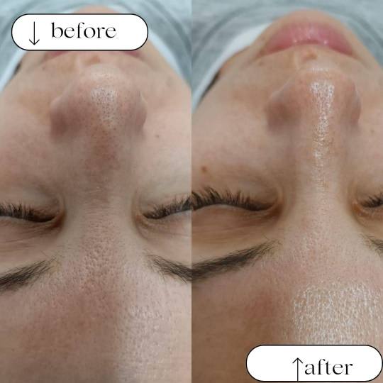MediBella Aesthetic Dedinje #beograd Tretman lica Hydrafacial - tretman lica Hydrafacial tretman je 