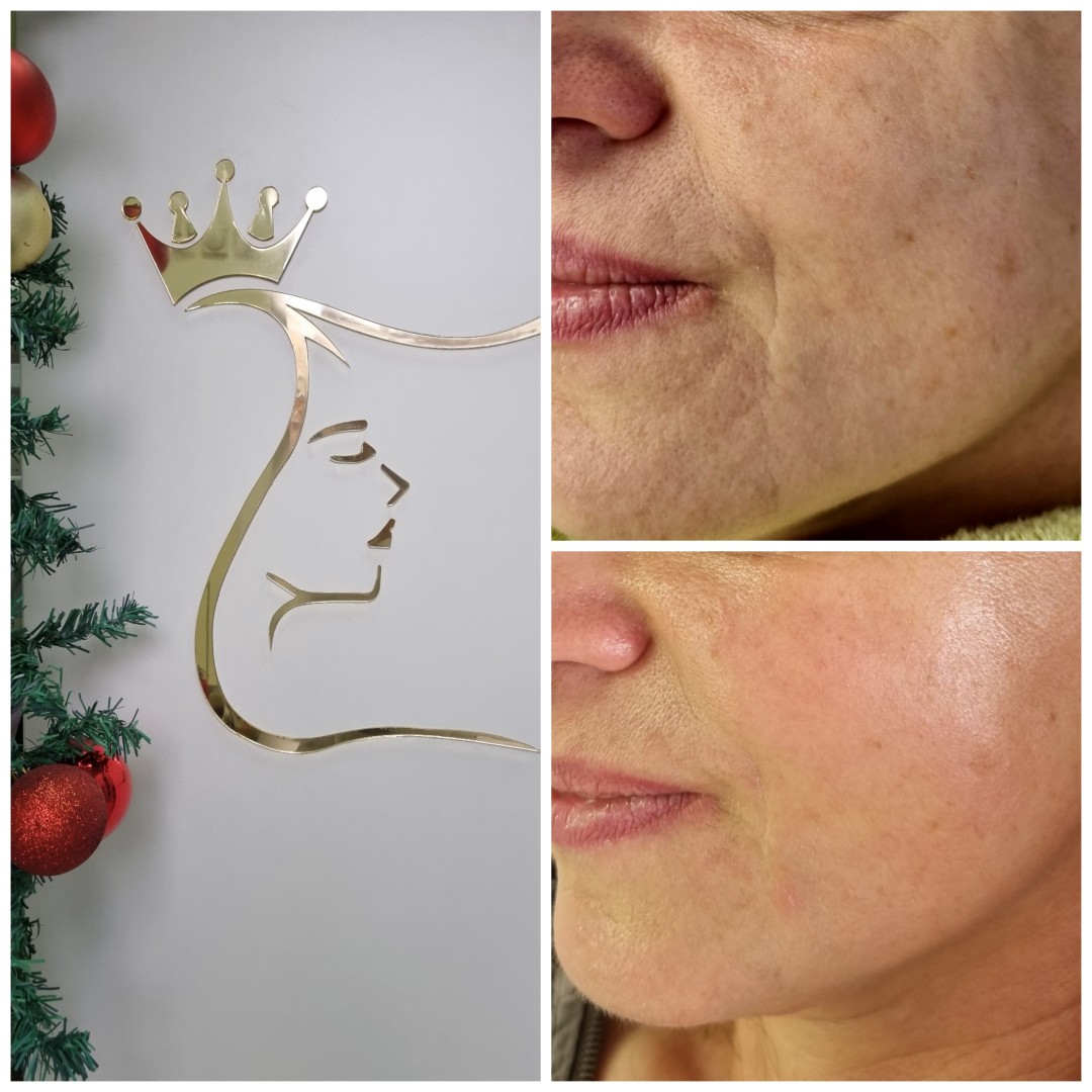 Emilly #beograd Tretman lica Skin boosters tretman lica