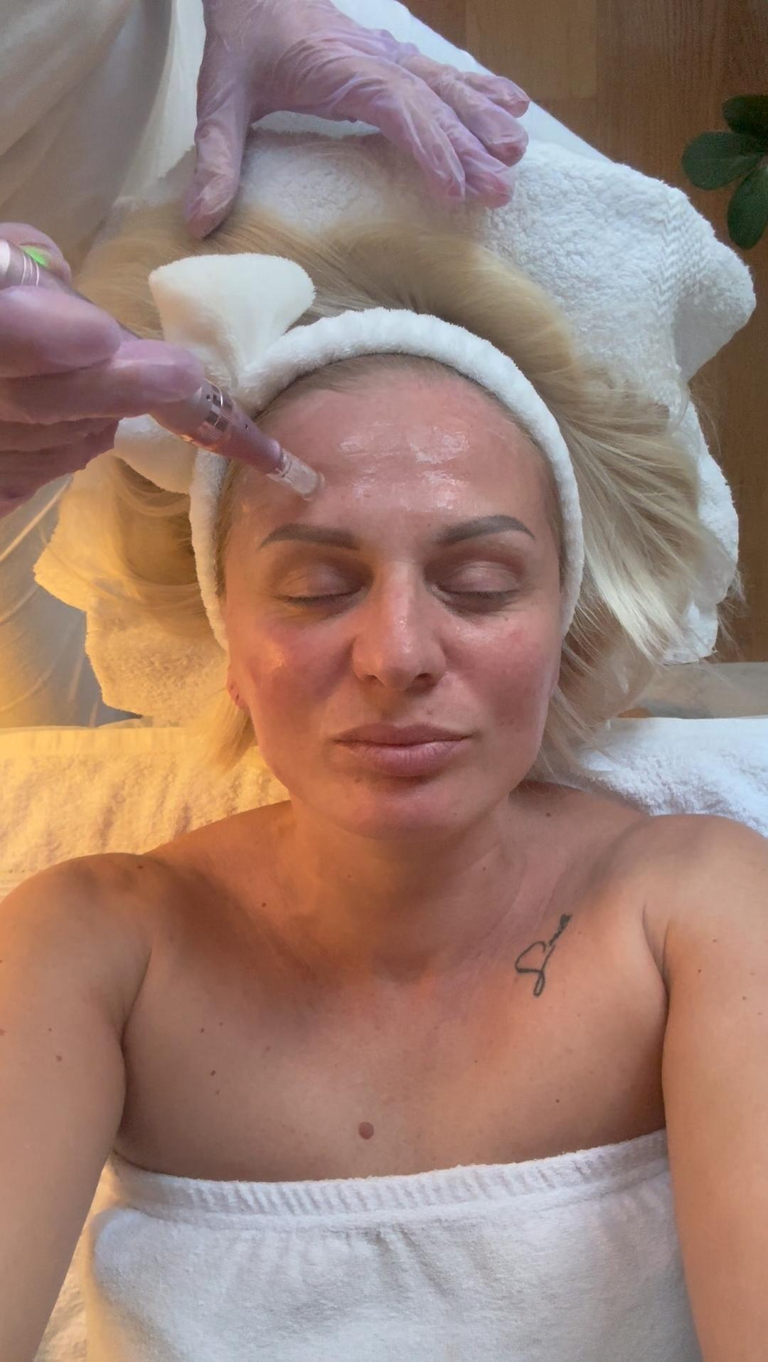 Glow Holistic Studio #beograd Dermaroler i dermapen Dermapen - lice + vrat + dekolte
