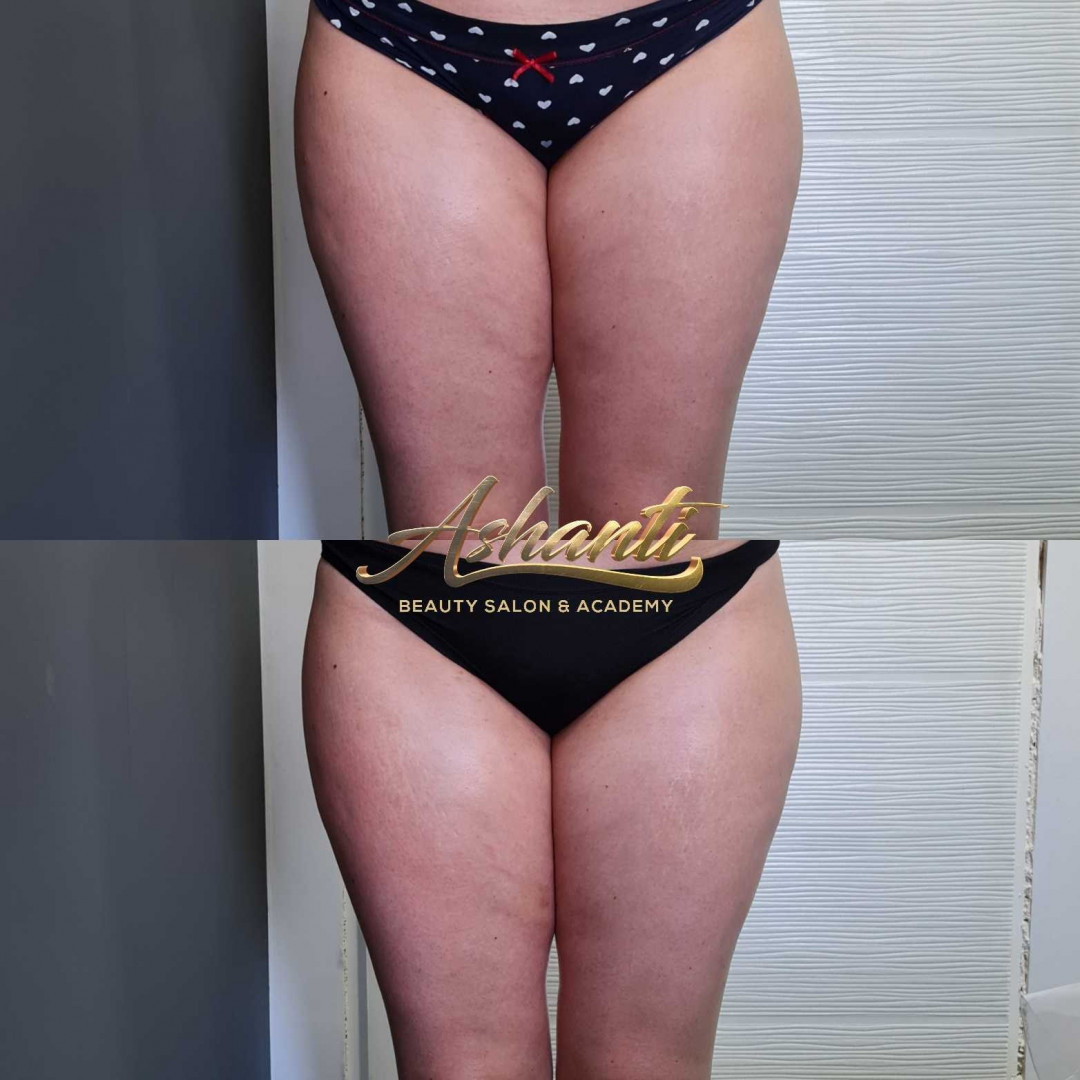 Ashanti Beauty Salon & Academy #beograd Masaža za mršavljenje Dermapen - regija lica
