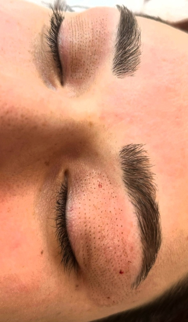 Esthetique Privé #beograd Tretman lica Plazma pen - po regiji