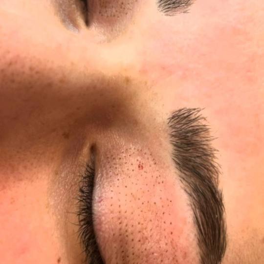 Esthetique Privé #beograd Tretman lica Plazma pen - po regiji