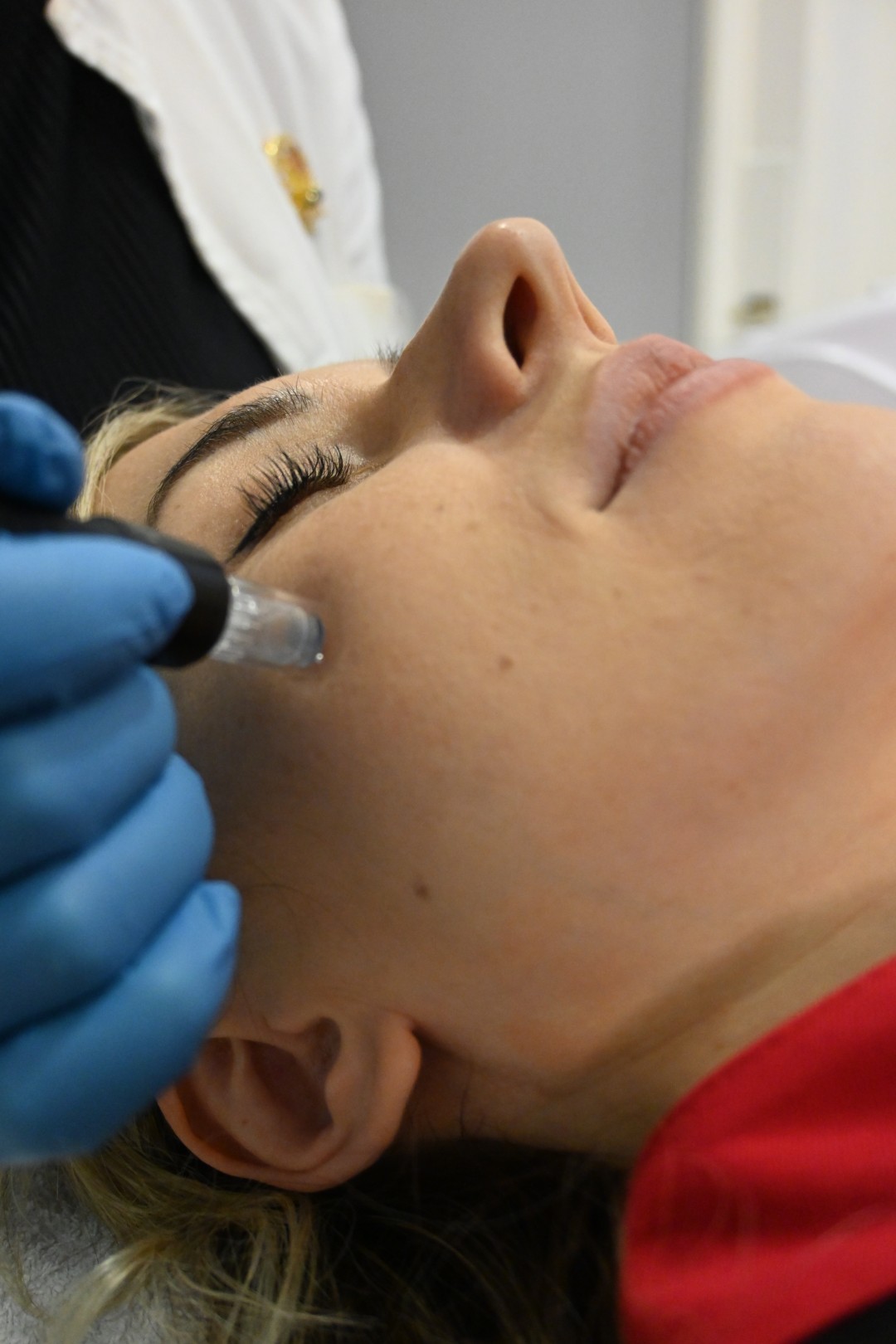 Angels #novisad Dermaroler i dermapen Dermapen Tretman Lica