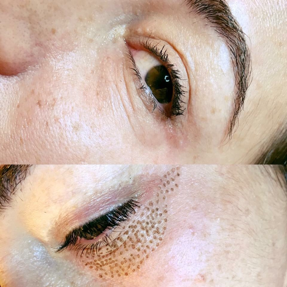 Vila Beauty Studio #beograd Tretman lica Plasma pen (po regiji)