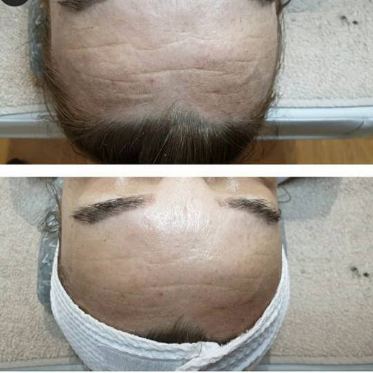 Zen Beauty #nis Hijaluronski tretmani lica Zen beauty Filler tretman