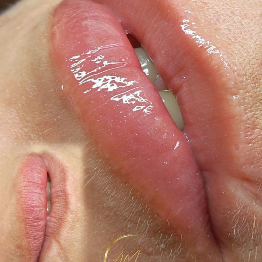 AM BEAUTY STUDIO #odzaci Dermaroler i dermapen HYDRA LIPS