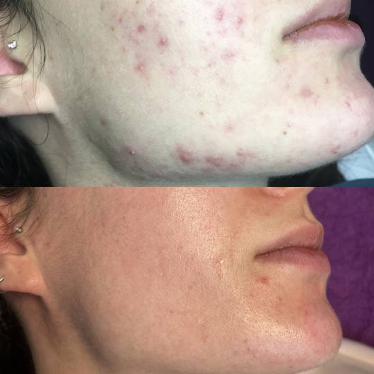ReNova nutri & beauty #beograd Tretman lica Hemijski piling lica - paket od 6 tretmana