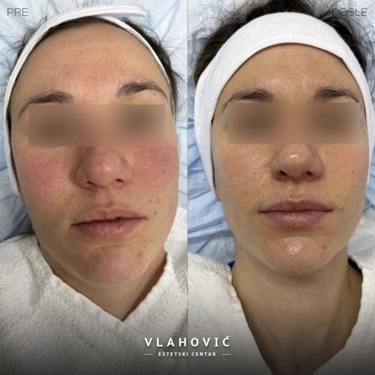 Estetski centar Vlahović #beograd Tretman lica HYDRAFACIAL - regeneracija i rejuvenacija kože HYDR