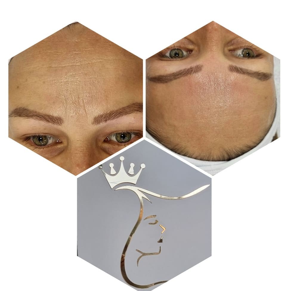 Emilly #beograd Tretman lica Biorevitalizacija lica