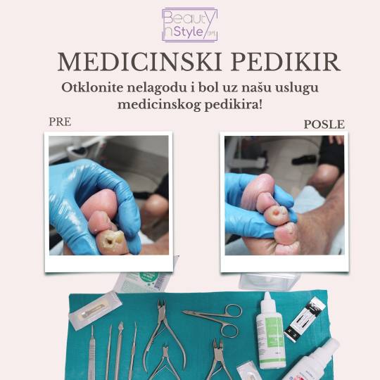Beauty in Style DM #novisad Medicinski pedikir Medicinski pedikir -urasli nokti, žuljevi, kurije o