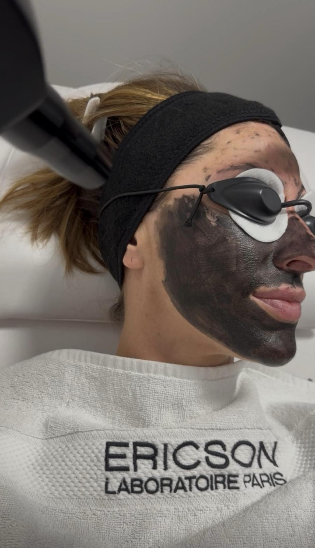 Elevent #beograd Tretman lica Laserski karbon piling lica - holivudski ten