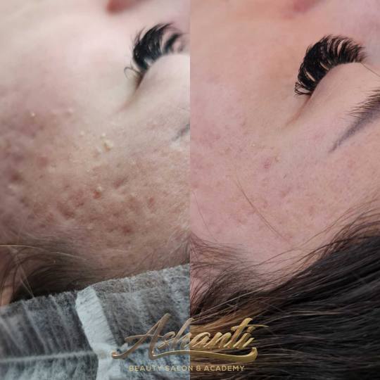 Ashanti Beauty Salon & Academy #beograd Dermaroler i dermapen Dermapen - celo lice