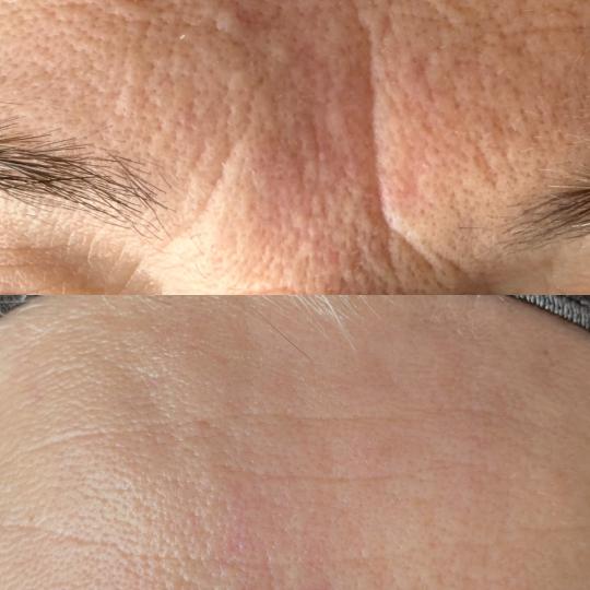 Lola esthetic center #beograd Tretman lica Multi vita - vitaminski antiage tretman 60+ Rezultati nak