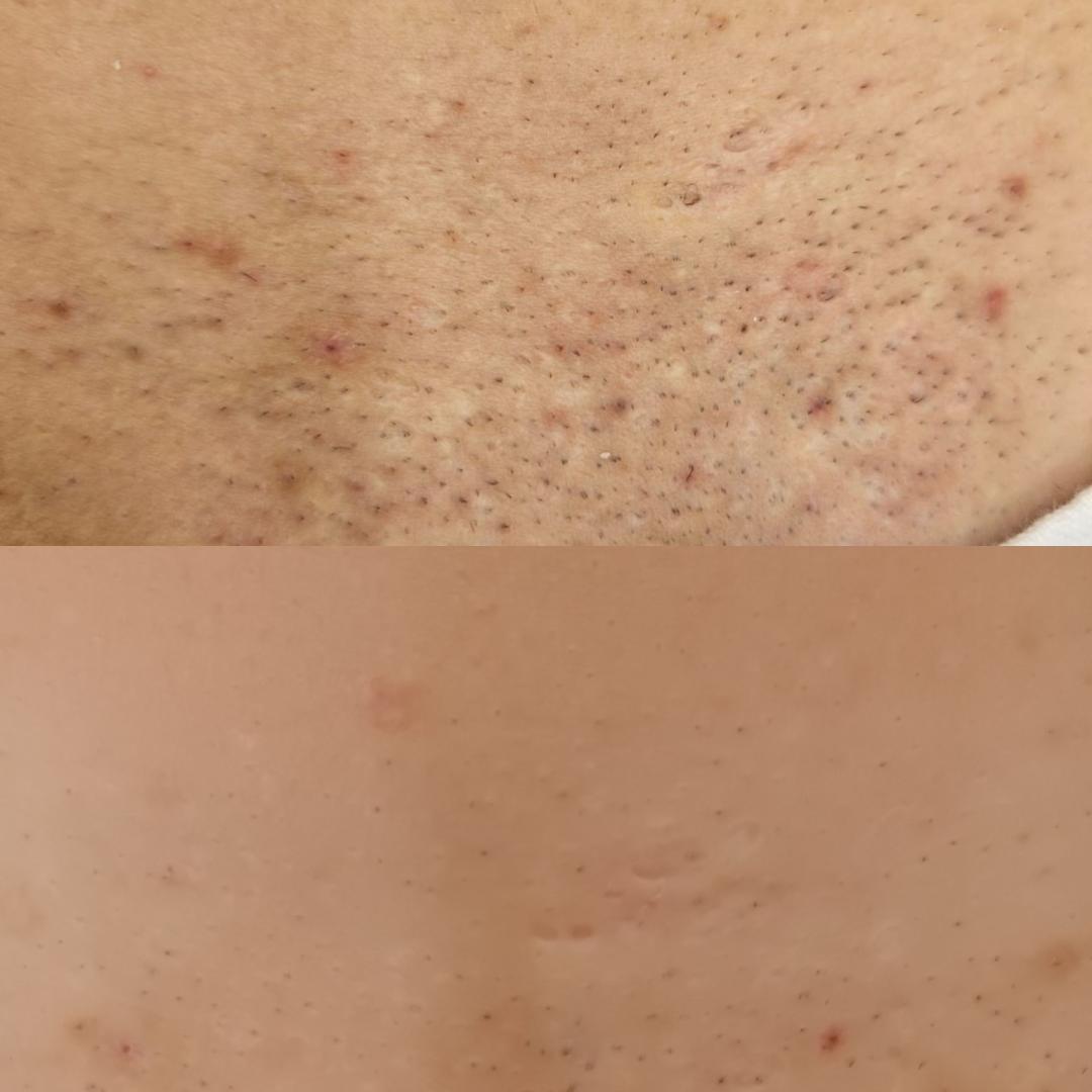 Choco Love #beograd Laserska epilacija Brazilska laserska epilacija - za dame