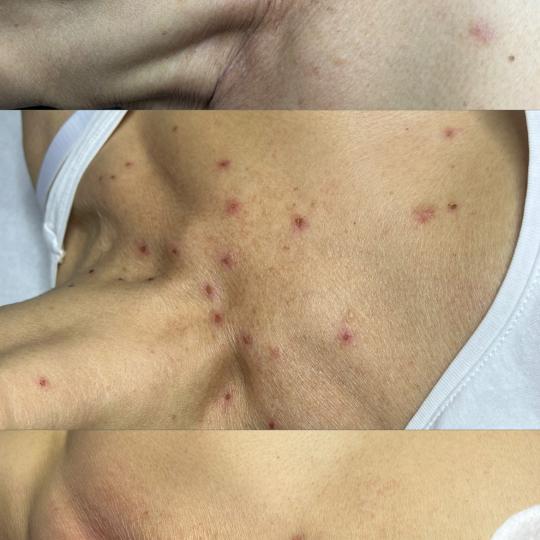 Belle Ana #beograd Tretman lica Phi-Ion tretman - bradavice / papilomi / keratoze / milije / hiperpi