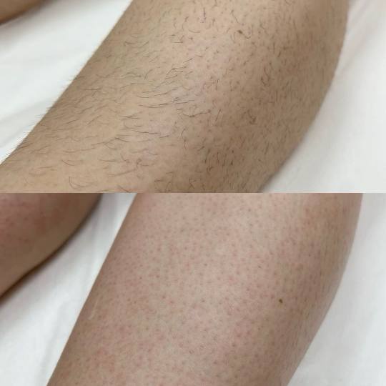 Nega i lepota NS 1 #novisad Depilacija nogu Depilacija - Pola nogu do kolena ili butine