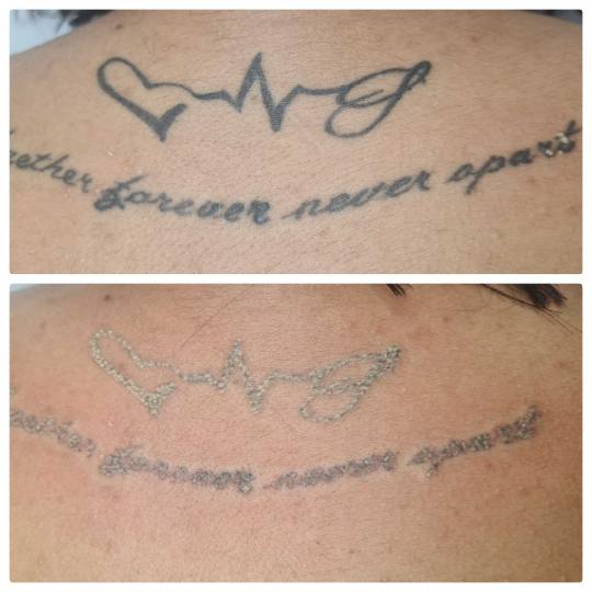 Laser centar Delight #beograd Uklanjanje tetovaža Uklanjanje tetovaže laserom - 1 boja 1cm2 - po t