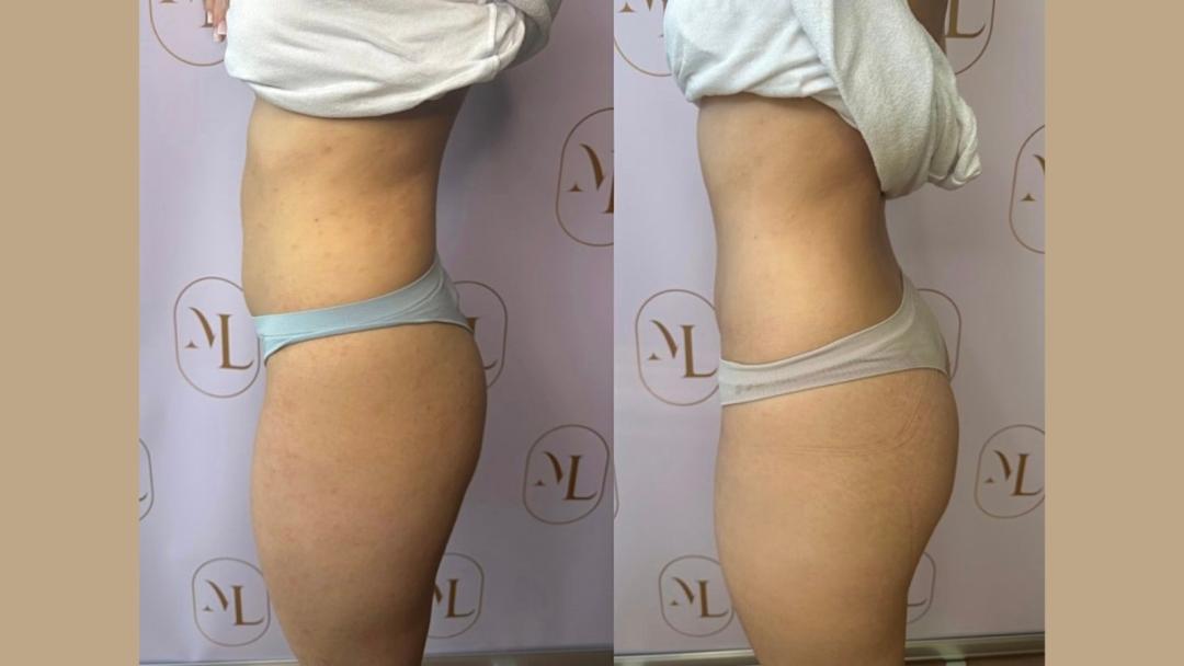 Personalizovani Attento tretmani tela - paket od 6 tretmana - Attento Aesthetic, Beograd Tretmani tela Telo Tretmani tela, Beograd, Zvezdara