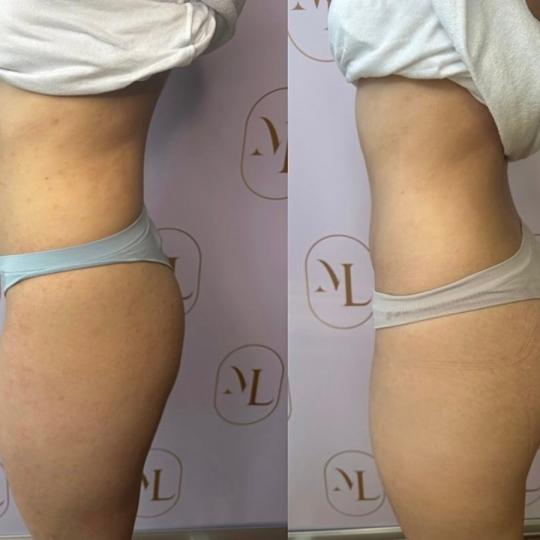 Attento Aesthetic #beograd Tretmani tela Personalizovani Attento tretmani tela - paket od 6 tretmana