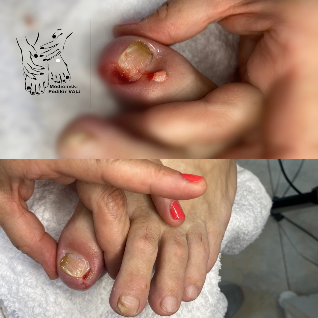 Vali&Nađa #novisad Medicinski pedikir Medicinski pedikir + urasli nokat