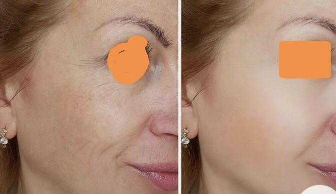 First lady #beograd Mezoterapija lica Mezoterapija lica dermapenom - uklanjanje bora sa celog lica