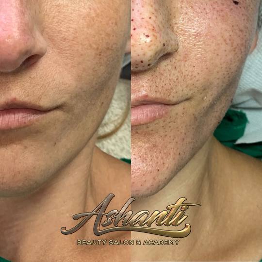Ashanti Beauty Salon & Academy #beograd Tretman lica Plasma pen - celo lice
