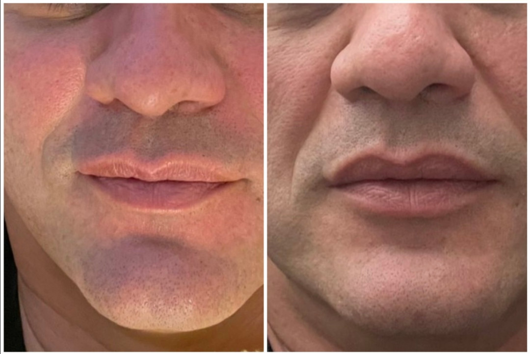Lipolaser Centar - Matrix021 #novisad Tretman lica