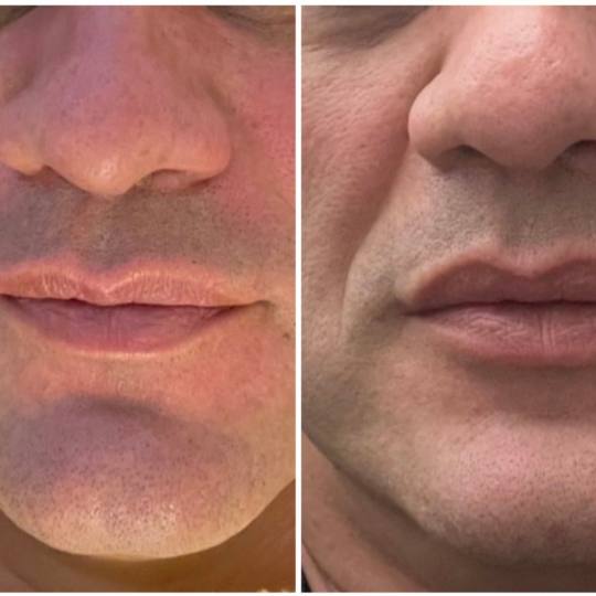 Lipolaser Centar - Matrix021 #novisad Tretman lica Zatezanje lica bez bola, na prirodan način obnav