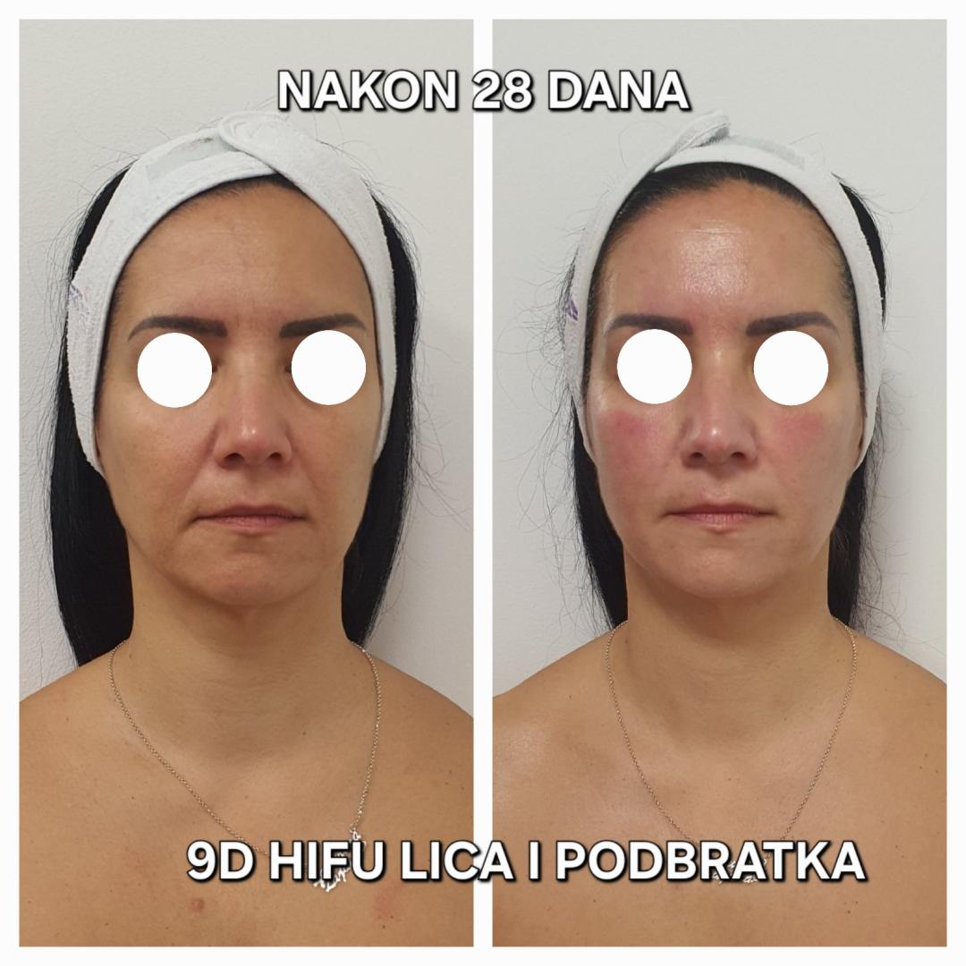 Beauty Vreme za mene #novisad Tretman lica AKCIJA 9D HIFU LICA ,VRATA,PODBRATKA +HIGIJENSKI TRETMAN+OXYGEN TRETMAN