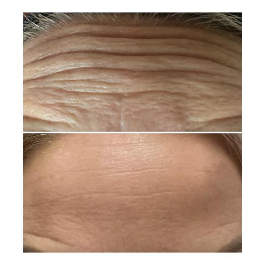 Beauty & Fashion #beograd Botox Botox - 3 regije