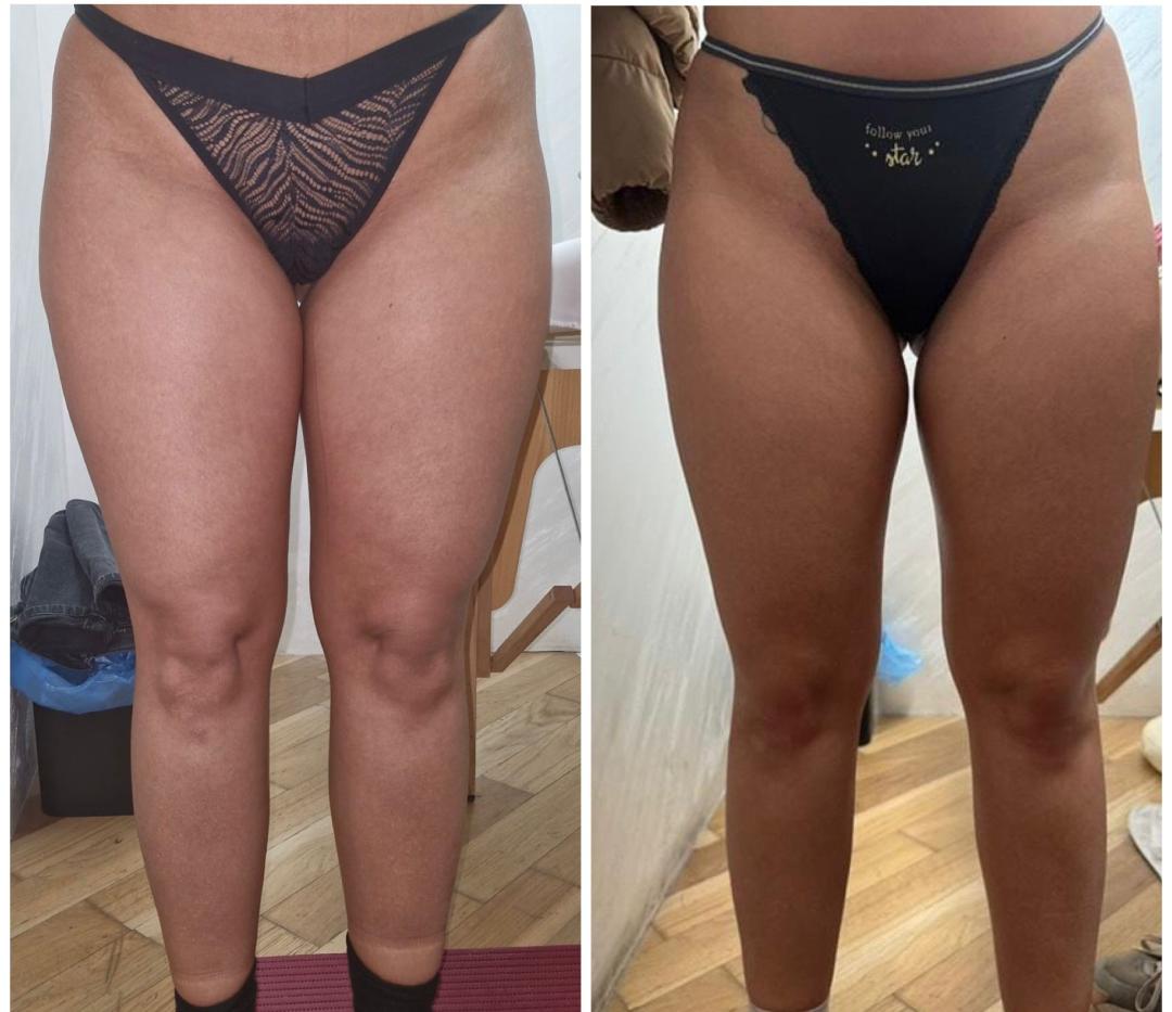 Exclusive Beauty Box #beograd Anticelulit masaža Maderoterapija - paket od 10 tretmana