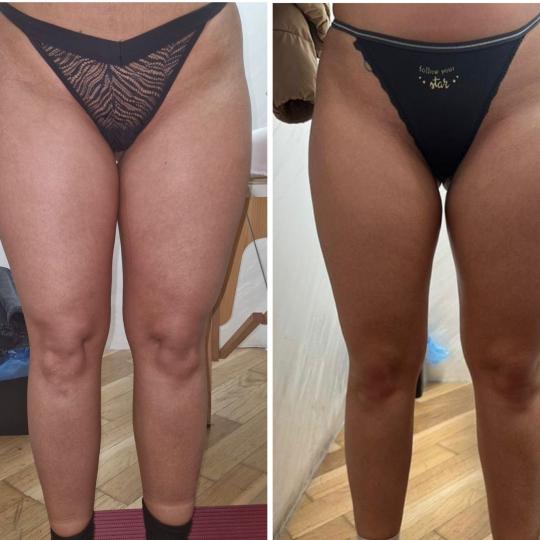 Exclusive Beauty Box #beograd Anticelulit masaža Maderoterapija - paket od 10 tretmana