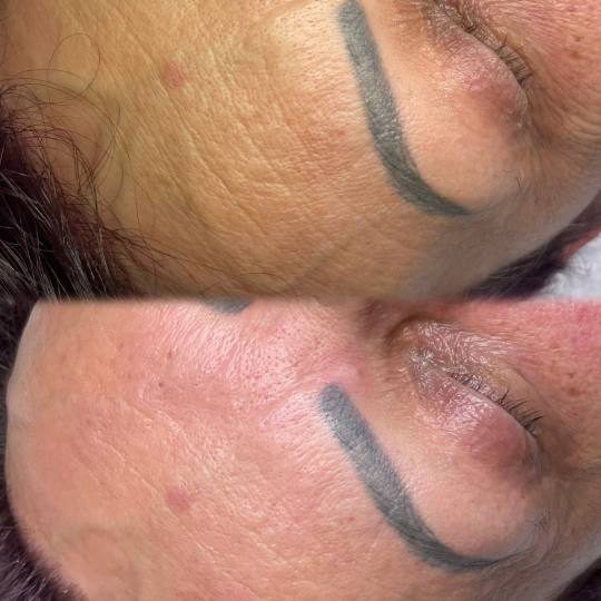 ReNova nutri & beauty #beograd Dermaroler i dermapen Dermapen + hemijski piling lica Indikacije: ant