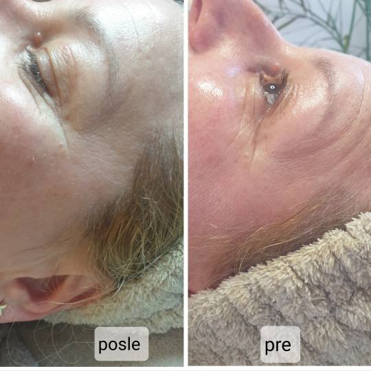 Pro Beauty Team #beograd Tretman lica Kolagenske niti - celo lice