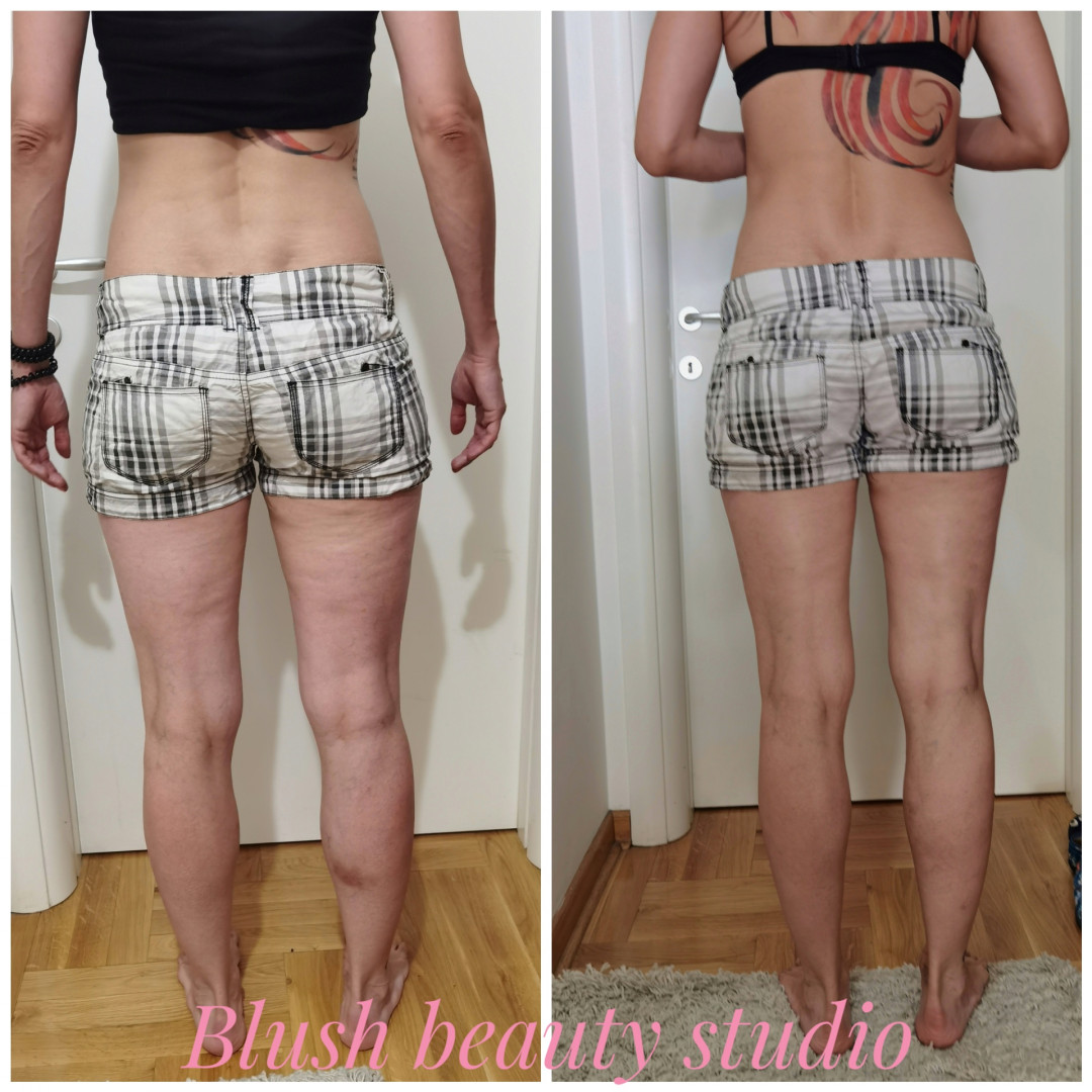 Blush Beauty Studio #beograd Anticelulit masaža Anticelulit masaža 45 minuta - paket od 10 tretmana