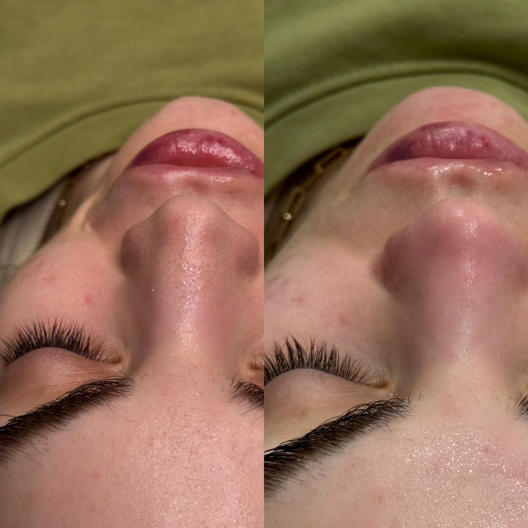 L’Avenue #beograd Tretman lica Higijenski tretman lica