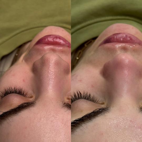 L’Avenue #beograd Tretman lica Higijenski tretman lica