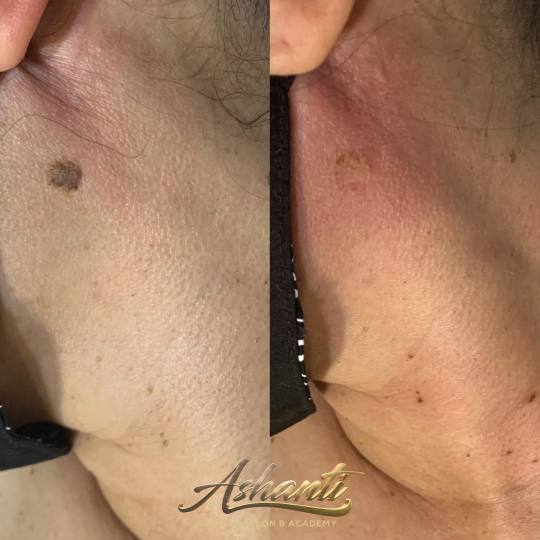 Ashanti Beauty Salon & Academy #beograd Tretman lica Plasma pen - skidanje do 10 bradavica