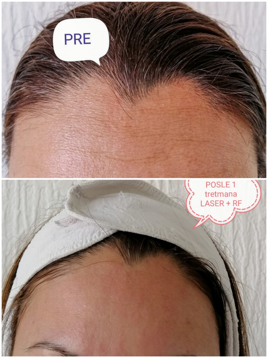 Lipolaser Centar - Matrix021 #novisad Tretman lica