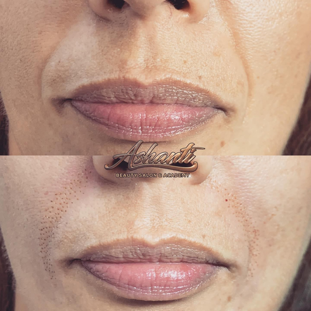 Plasma pen - nazolabijalne bore - Ashanti Beauty Salon & Academy, Beograd Tretman lica Lice Tretman lica, Beograd, Voždovac