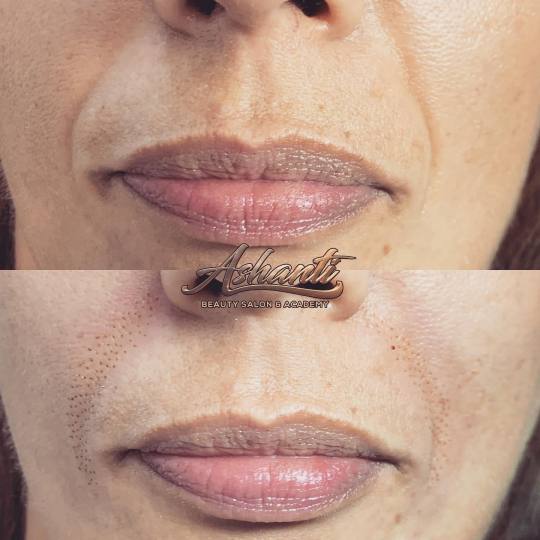 Ashanti Beauty Salon & Academy #beograd Tretman lica Plasma pen - nazolabijalne bore
