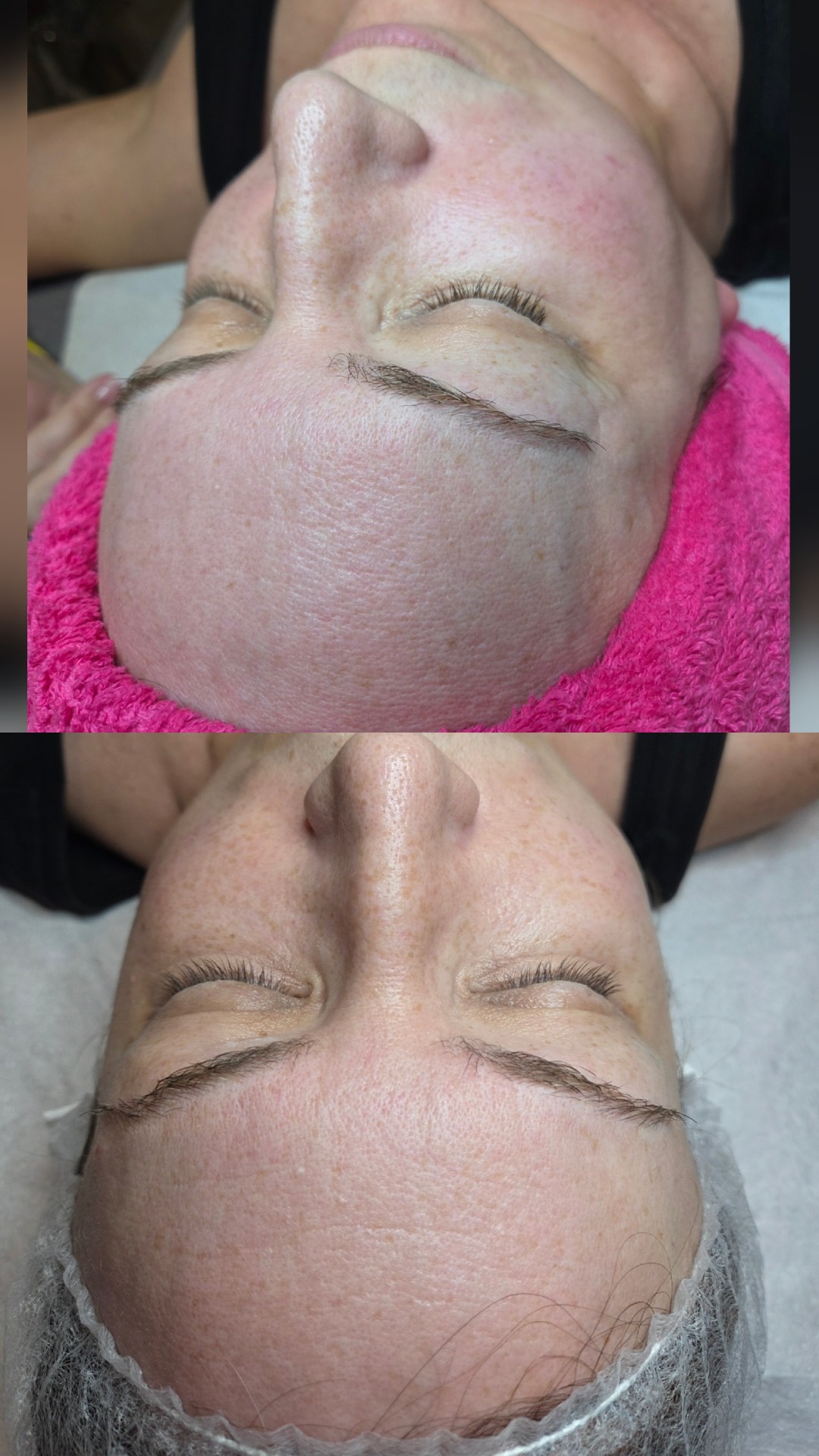 Holivudski sjaj - Jessner - Starmedic, Beograd Dermaroler i dermapen Lice Dermaroler i dermapen, Beograd, Vračar, Čubura, Crveni krst