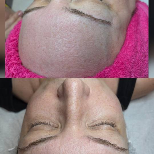 Starmedic #beograd Dermaroler i dermapen Holivudski sjaj - Jessner