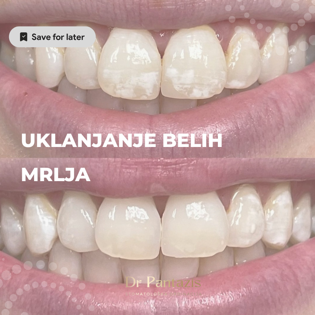 Dr Pantazis - Dental & Beauty Clinic #beograd Zubi Lasersko Profesionalno Izbeljivanje Zuba