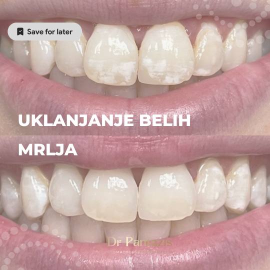 Dr Pantazis - Dental & Beauty Clinic #beograd Zubi Lasersko Profesionalno Izbeljivanje Zuba